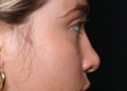 Rhinoplasty Before & After Patient #31578