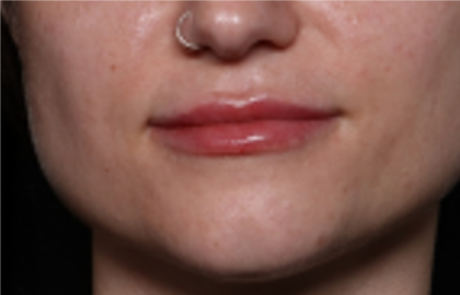 Lip Filler Before & After Patient #31732