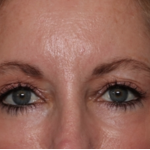 Blepharoplasty and Brow Lift Before & After Patient #31497