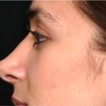 Rhinoplasty Before & After Patient #31744