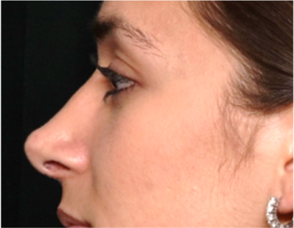 Rhinoplasty Before & After Patient #31744