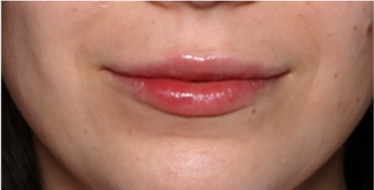 Lip Filler Before & After Patient #31757