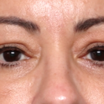 Blepharoplasty and Brow Lift Before & After Patient #31590