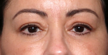 Blepharoplasty and Brow Lift Before & After Patient #31590