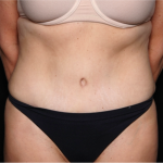 Tummy Tuck Before & After Patient #31832