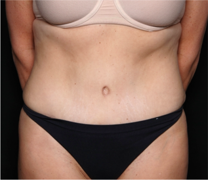 Tummy Tuck Before & After Patient #31832