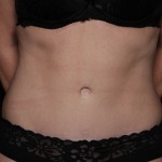 Tummy Tuck Before & After Patient #31601