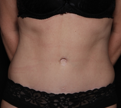 Tummy Tuck Before & After Patient #31601