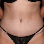 Tummy Tuck Before & After Patient #31639