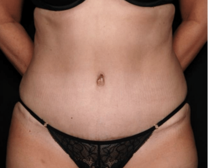 Tummy Tuck Before & After Patient #31639