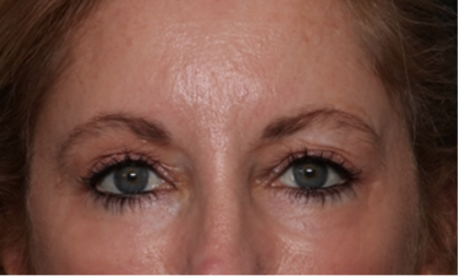 Blepharoplasty and Brow Lift Before & After Patient #31497