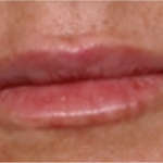 Lip Filler Before & After Patient #31689