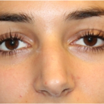 Rhinoplasty Before & After Patient #31744