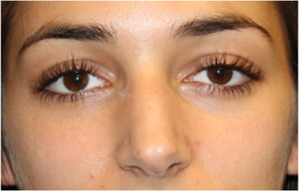 Rhinoplasty Before & After Patient #31744