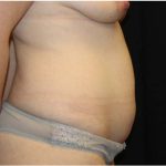 Tummy Tuck Before & After Patient #31821