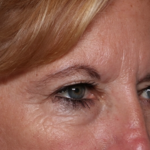 Blepharoplasty and Brow Lift Before & After Patient #31497