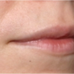 Lip Filler Before & After Patient #31757