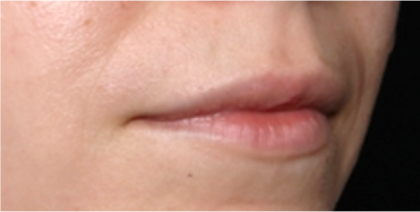 Lip Filler Before & After Patient #31757