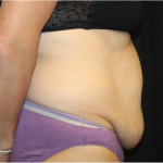 Tummy Tuck Before & After Patient #31832