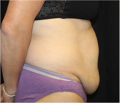 Tummy Tuck Before & After Patient #31832