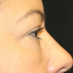 Blepharoplasty and Brow Lift Before & After Patient #31590