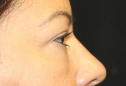 Blepharoplasty and Brow Lift Before & After Patient #31590