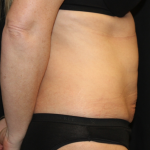 Tummy Tuck Before & After Patient #31601