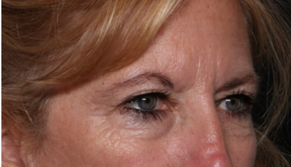 Blepharoplasty and Brow Lift Before & After Patient #31497