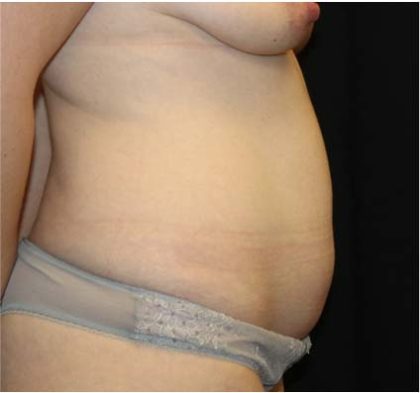 Tummy Tuck Before & After Patient #31821