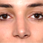 Rhinoplasty Before & After Patient #31744