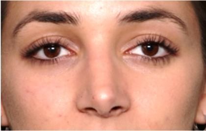 Rhinoplasty Before & After Patient #31744