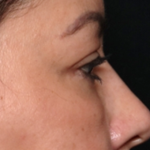 Blepharoplasty and Brow Lift Before & After Patient #31590