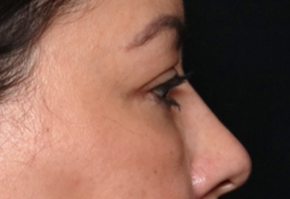 Blepharoplasty and Brow Lift Before & After Patient #31590