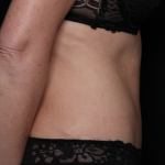 Tummy Tuck Before & After Patient #31601
