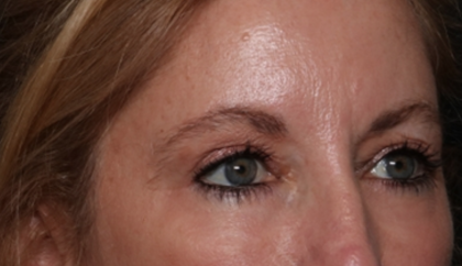 Blepharoplasty and Brow Lift Before & After Patient #31497