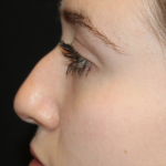 Rhinoplasty Before & After Patient #31578