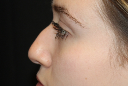Rhinoplasty Before & After Patient #31578