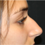 Rhinoplasty Before & After Patient #31744