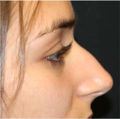 Rhinoplasty Before & After Patient #31744