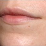 Lip Filler Before & After Patient #31757