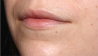 Lip Filler Before & After Patient #31757