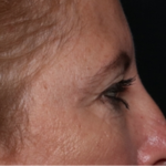 Blepharoplasty and Brow Lift Before & After Patient #31497