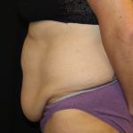 Tummy Tuck Before & After Patient #31832