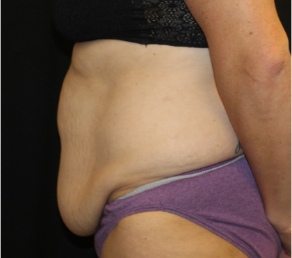 Tummy Tuck Before & After Patient #31832