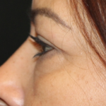 Blepharoplasty and Brow Lift Before & After Patient #31590