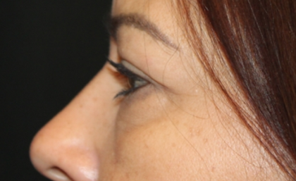 Blepharoplasty and Brow Lift Before & After Patient #31590