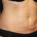 Tummy Tuck Before & After Patient #31601