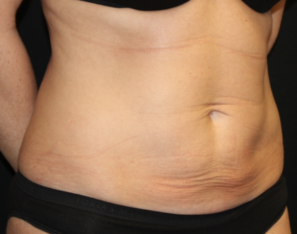 Tummy Tuck Before & After Patient #31601