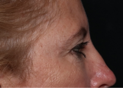 Blepharoplasty and Brow Lift Before & After Patient #31497