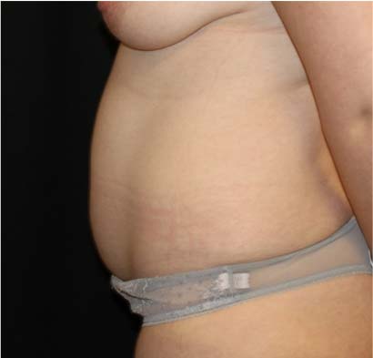 Tummy Tuck Before & After Patient #31821